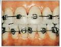 Orthodontic Braces