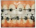 Orthodontic Braces